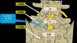 L5神経根鍼治療