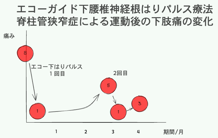 エコーガイド化腰椎神経根はり治療　狭窄症